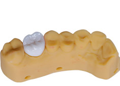 Implant dental model